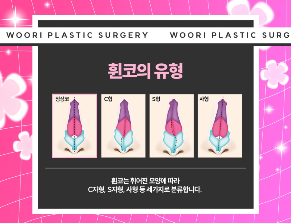 휜 코성형 방법과 코 수술 비용, 가격 궁금하다면 관련 이미지 10