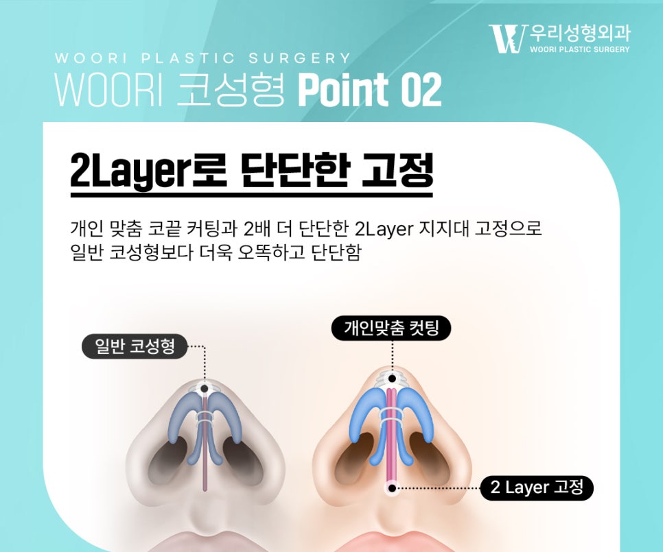 코재수술 흔들림과 휘어짐이 반복되는 이유 관련 이미지 3