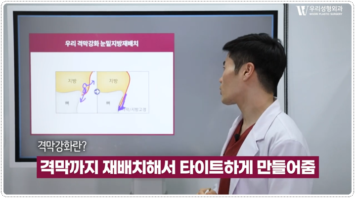 눈밑지방재배치 격막강화술이란 무엇일까 관련 이미지 4