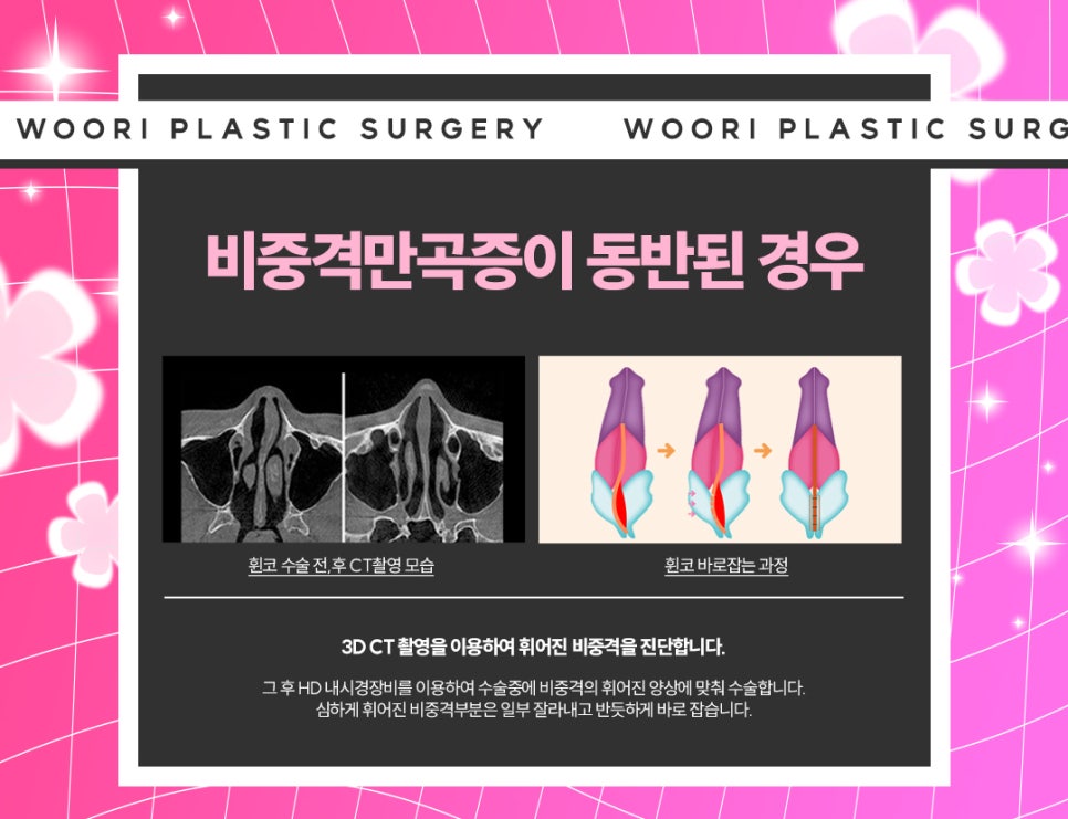 휜 코성형 방법과 코 수술 비용, 가격 궁금하다면 관련 이미지 9