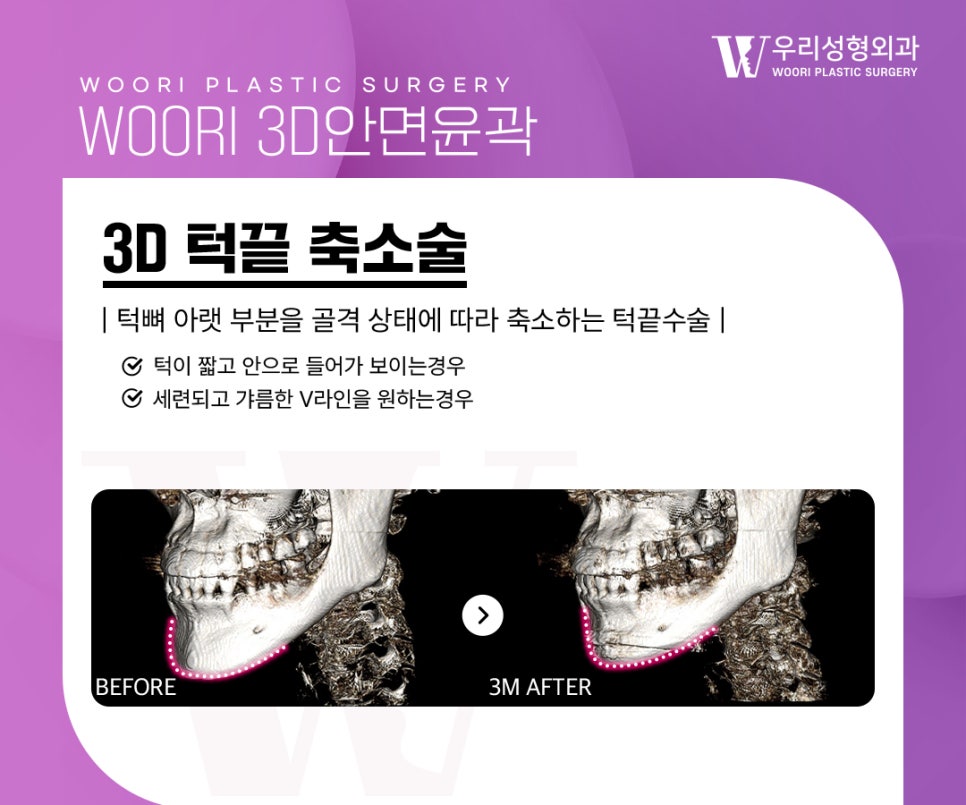 안면윤곽수술 자연스러운 얼굴선을 위해 중요한 것은? 관련 이미지 5