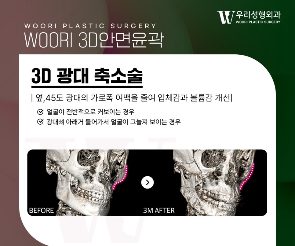 안면윤곽 제대로 알고 선택해야 하는 이유 관련 이미지 2