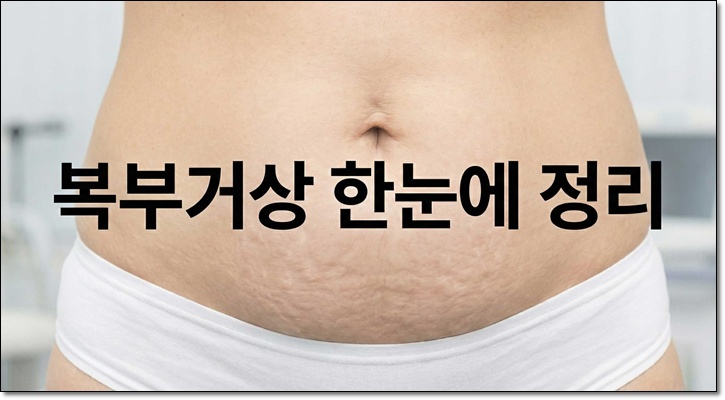 복부거상술 미니복부거상 차이 정리 관련 이미지 1