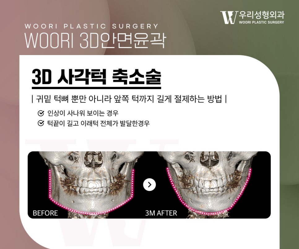 안면윤곽수술 3종을 함께 하는 이유는 무엇일까요? 관련 이미지 2