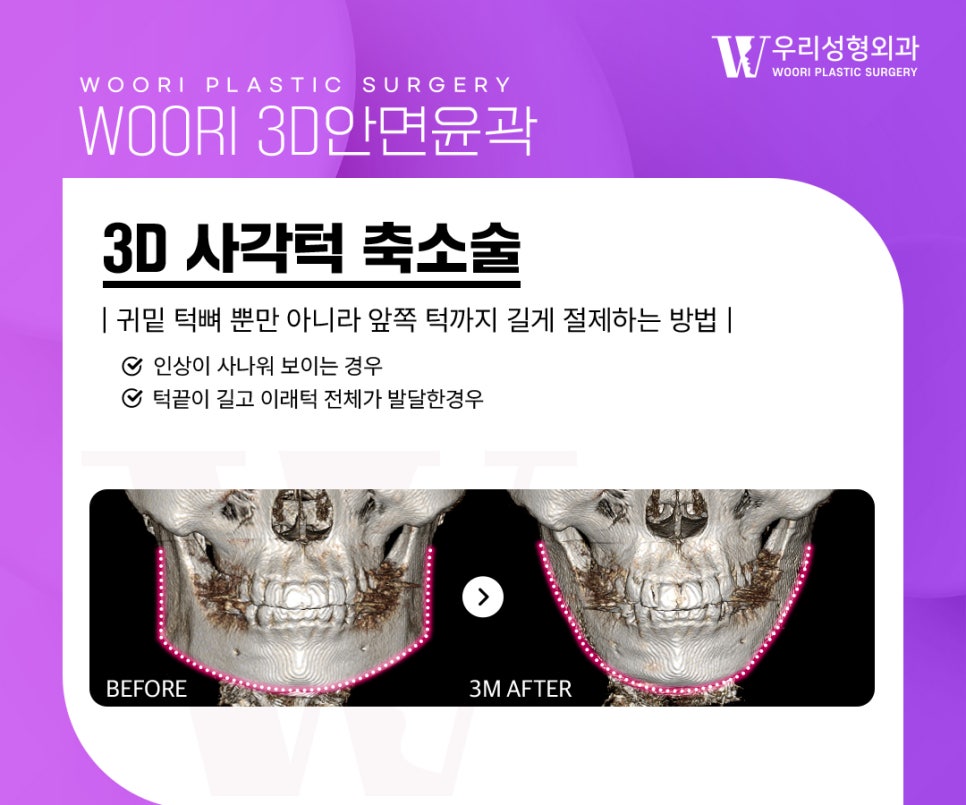 윤곽3종 한 가지 수술만으로는 부족한 이유 관련 이미지 2