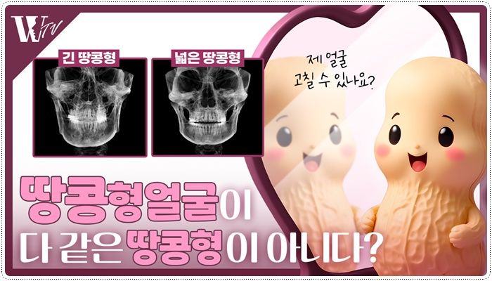 안면윤곽수술방법 땅콩형 얼굴은? 관련 이미지 1