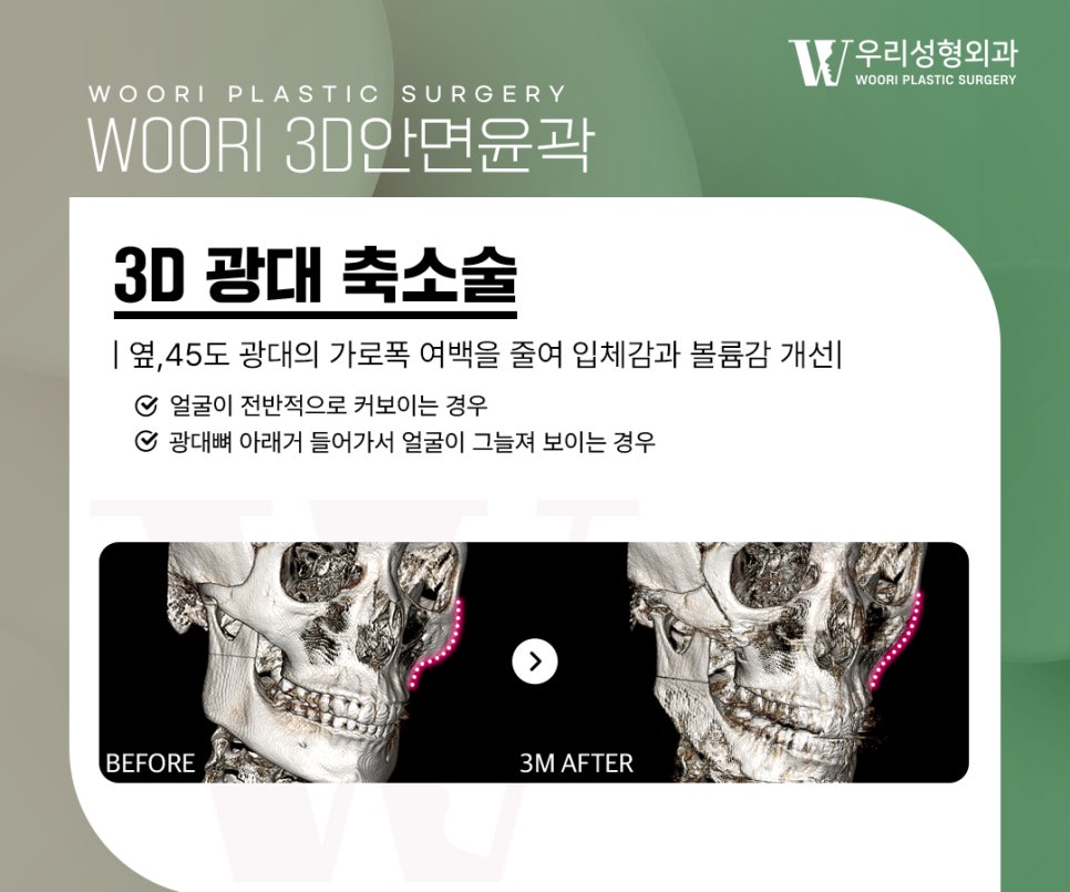 광대축소술 후 인상이 달라지는 이유 관련 이미지 2