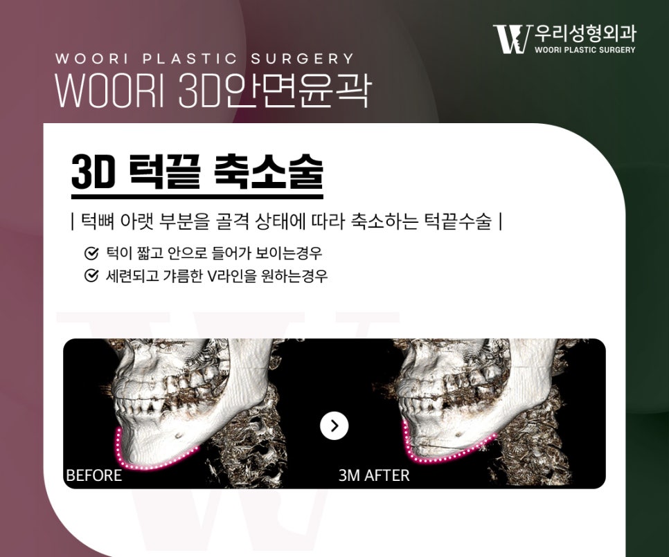 안면윤곽수술 얼굴형이 강해보이는 이유는? 관련 이미지 4