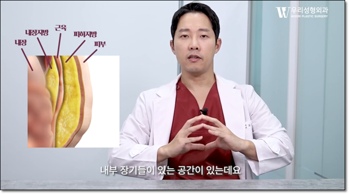 복부지방흡입 효과가 있으려면 관련 이미지 2