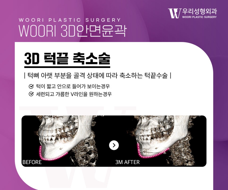 Facial Contouring Review: Do Square Jaw, Cheekbone, and Chin-Tip Surgery Have to Be Done Together? image 4