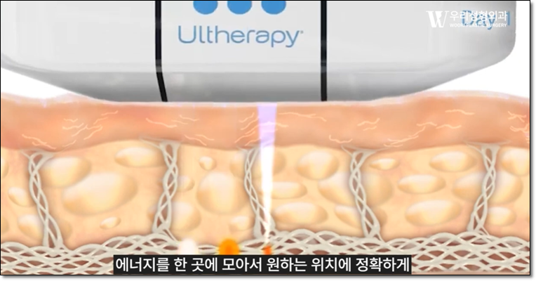 울쎄라 효과없음 그 이유는? 관련 이미지 2