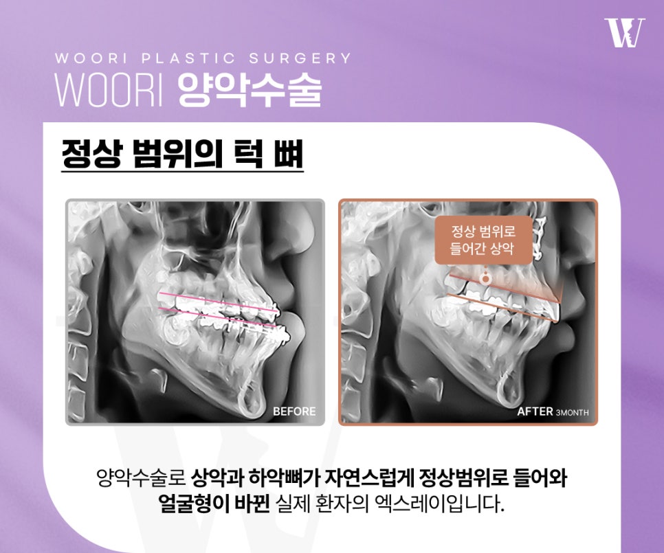 주걱턱교정 양악수술이 필요한 이유 관련 이미지 4