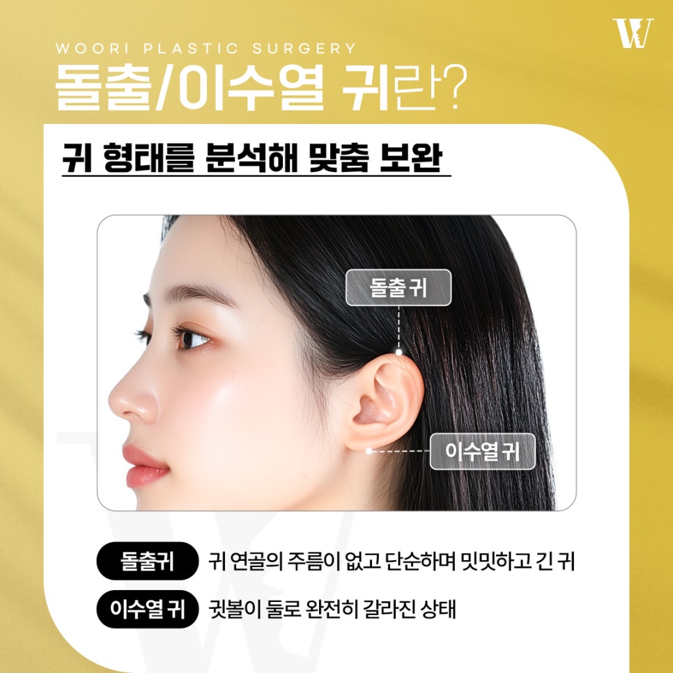 귀성형 균형 잡힌 귀 모양을 위한 선택 관련 이미지 2
