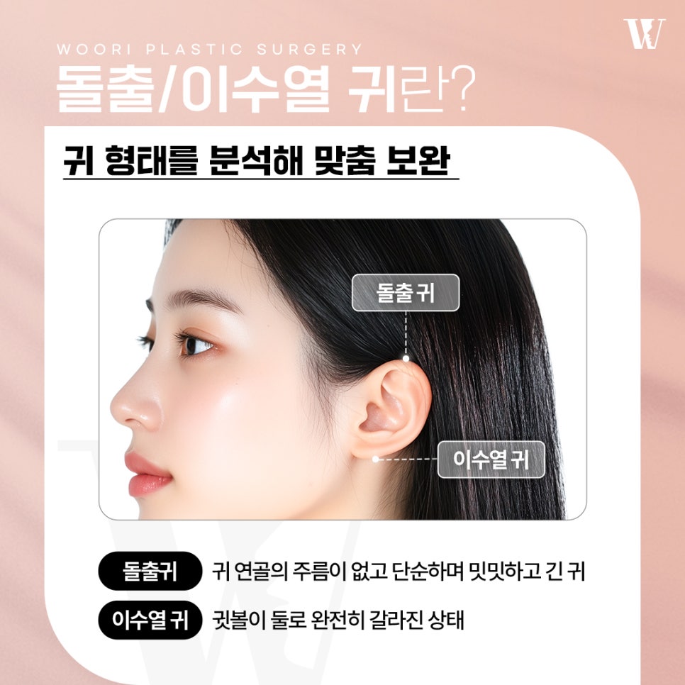 귀성형 귀 모양과 각도 정리로 달라지는 인상 관련 이미지 2