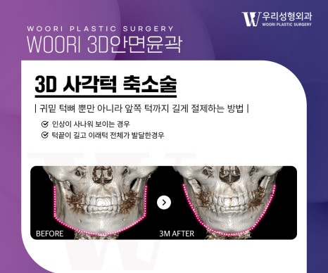 광대축소 윤곽수술 부위별 차이와 특징 관련 이미지 3