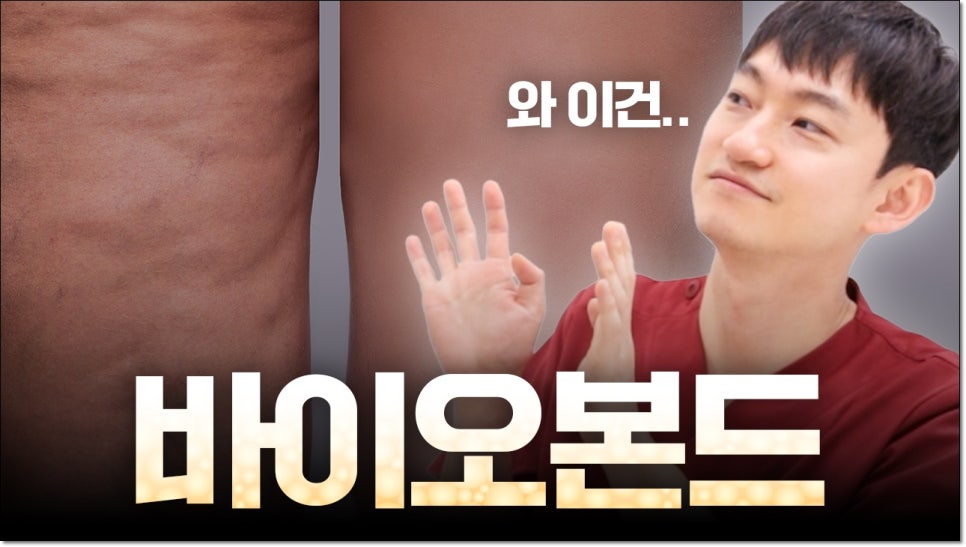 복부지방흡입 부작용 바이오본드 알아보기 관련 이미지 1