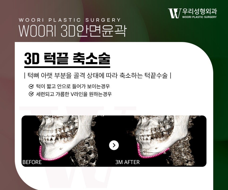 안면윤곽 제대로 알고 선택해야 하는 이유 관련 이미지 3