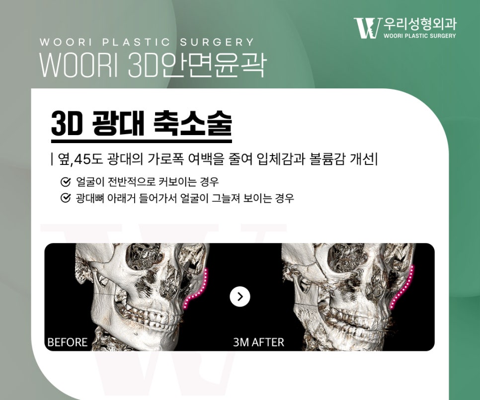 Why Does Facial Width Decrease After Contouring Surgery? image 2