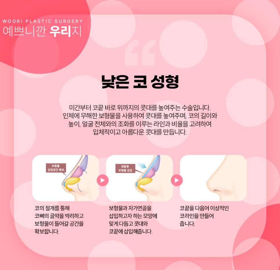 무보형물 코성형 안전한 코수술 후기와 비용은? 관련 이미지 5