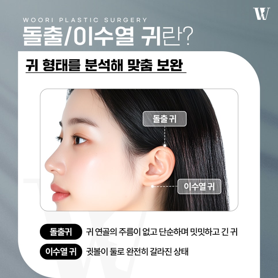 귀모양수술 귀 모양이 신경 쓰일 때 관련 이미지 2