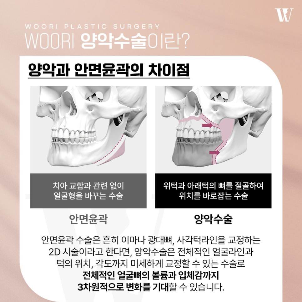 양악수술 얼굴의 균형을 되찾는 방법 관련 이미지 4