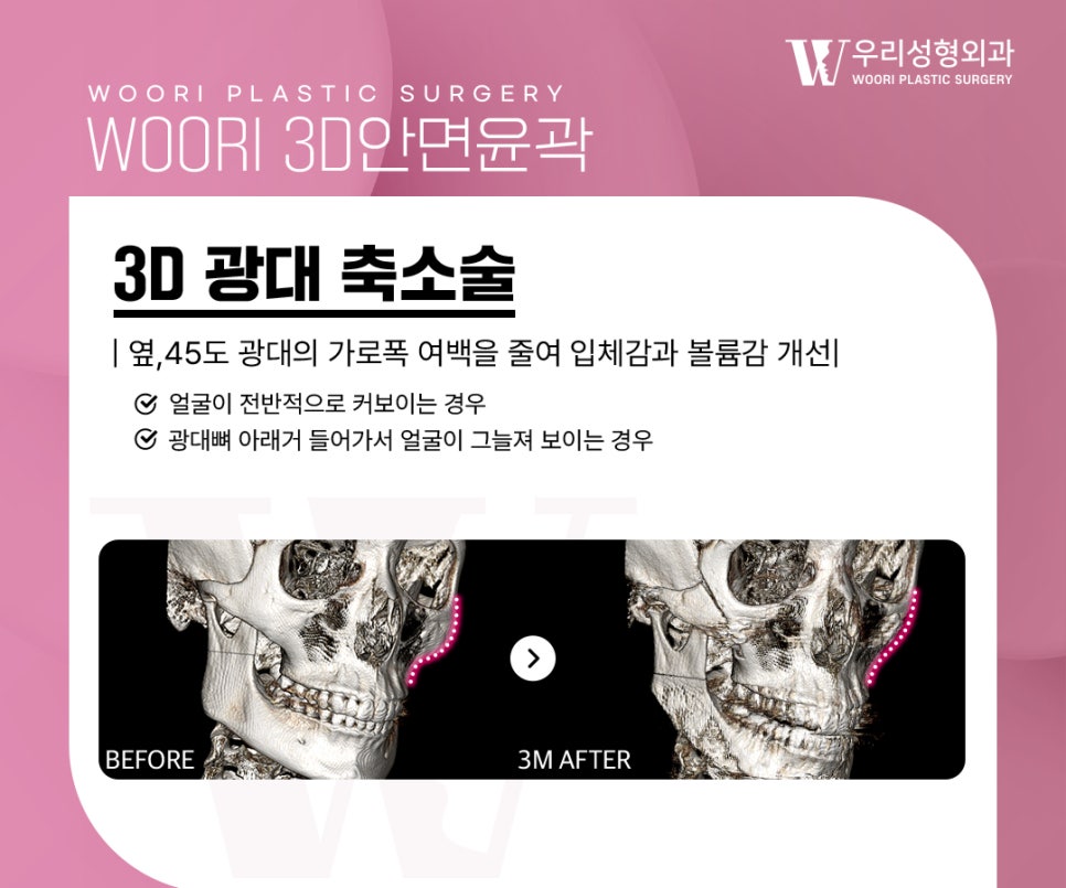 윤곽수술 광대, 사각턱, 턱끝을 모두 해야 할까요? 관련 이미지 3