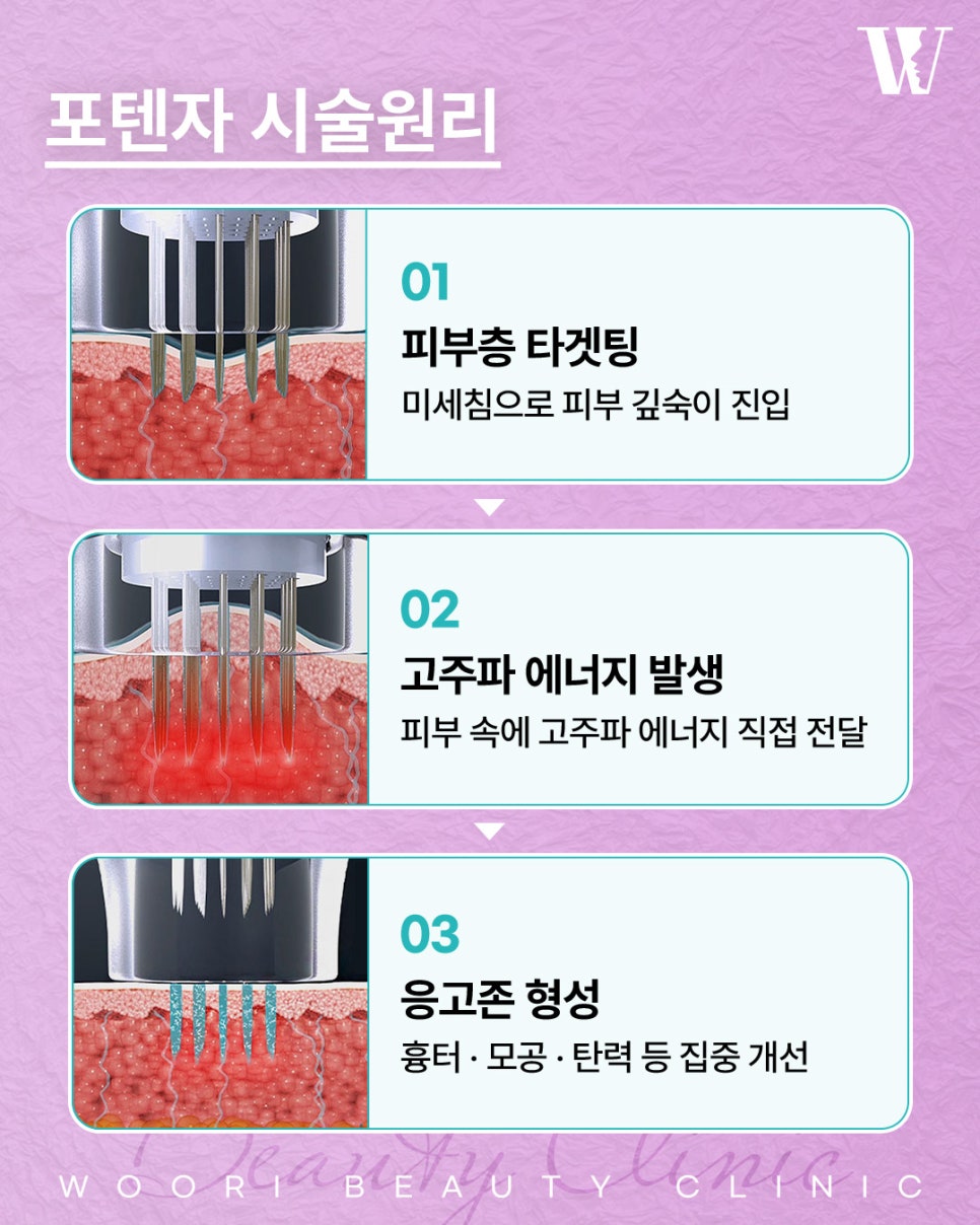 포텐자시술 피부 흉터와 모공이 신경 쓰일 때 관련 이미지 3