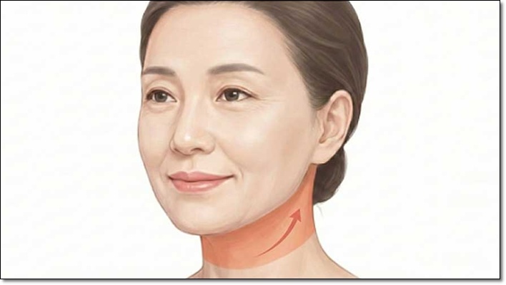 안면거상 미니거상 차이점은? 관련 이미지 4