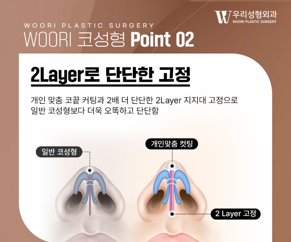 남자코수술에서 중요한 코끝 지지력 관련 이미지 3