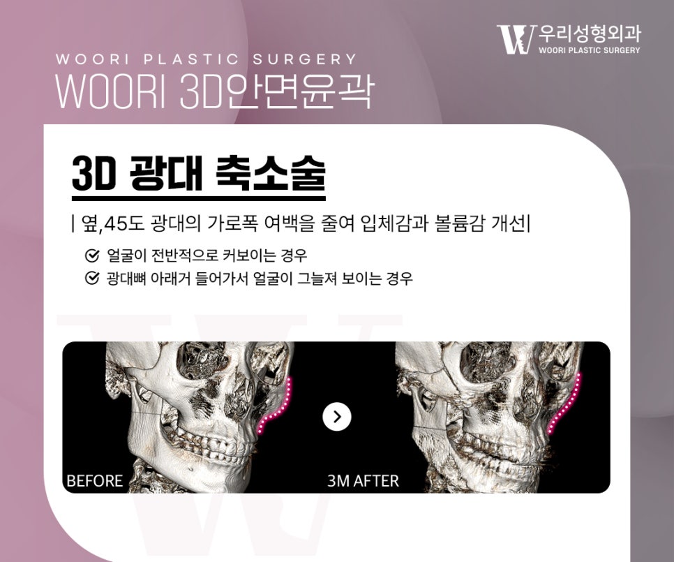 안면윤곽수술, 얼굴형을 정리하는 방법은? 관련 이미지 4