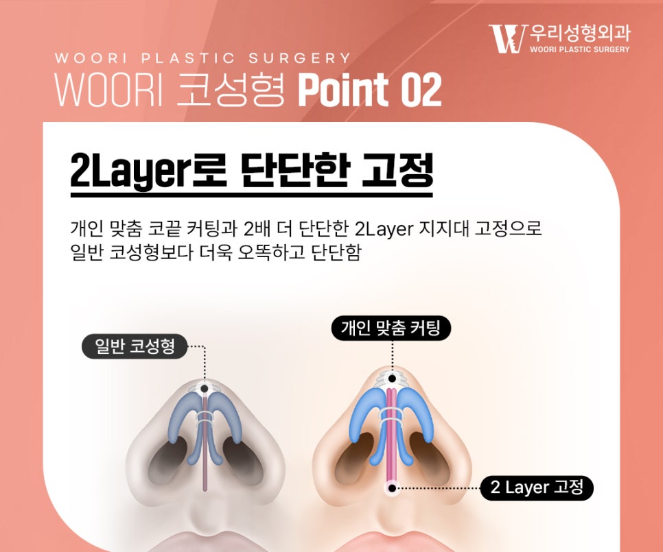 코성형결과 자연스러운 옆라인을 만드는 기준 관련 이미지 3