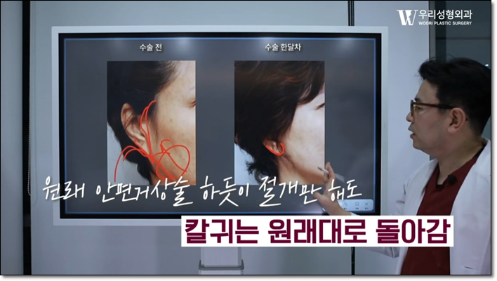 안면거상술 칼귀 걱정 된다면? 관련 이미지 5