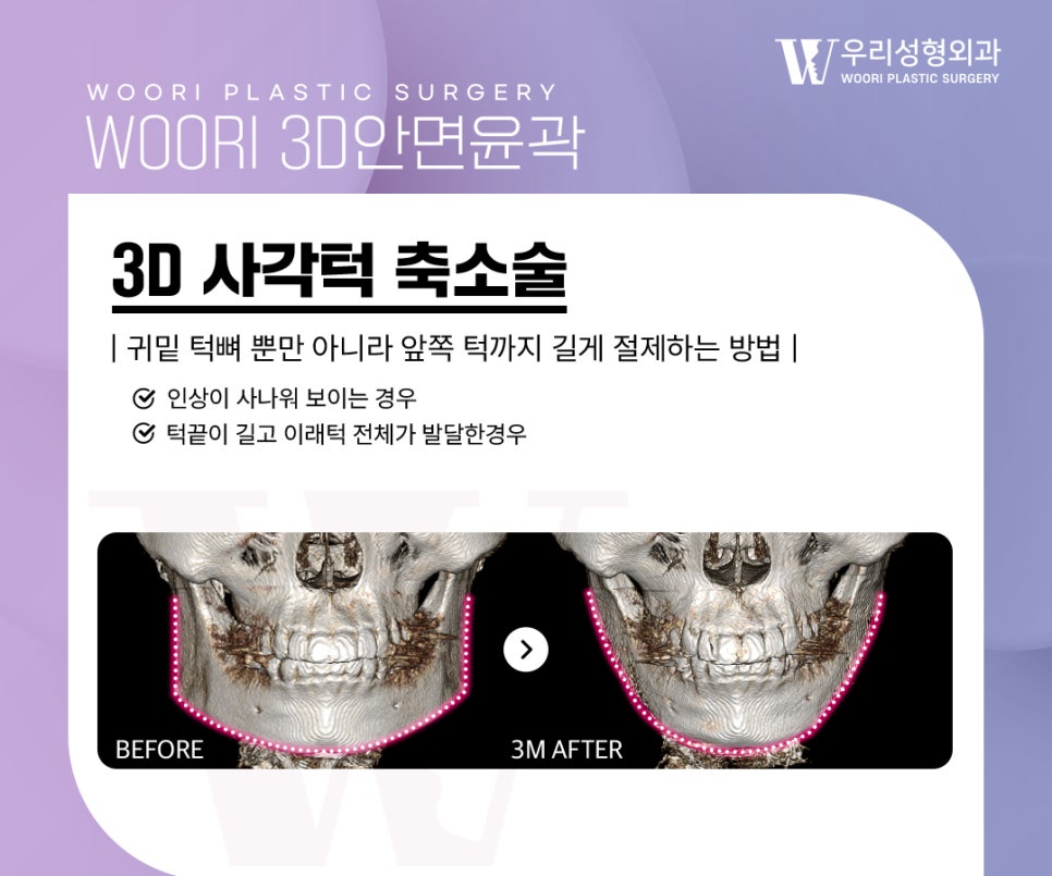 윤곽수술로 얼굴이 작아 보이는 이유는 무엇일까 관련 이미지 3