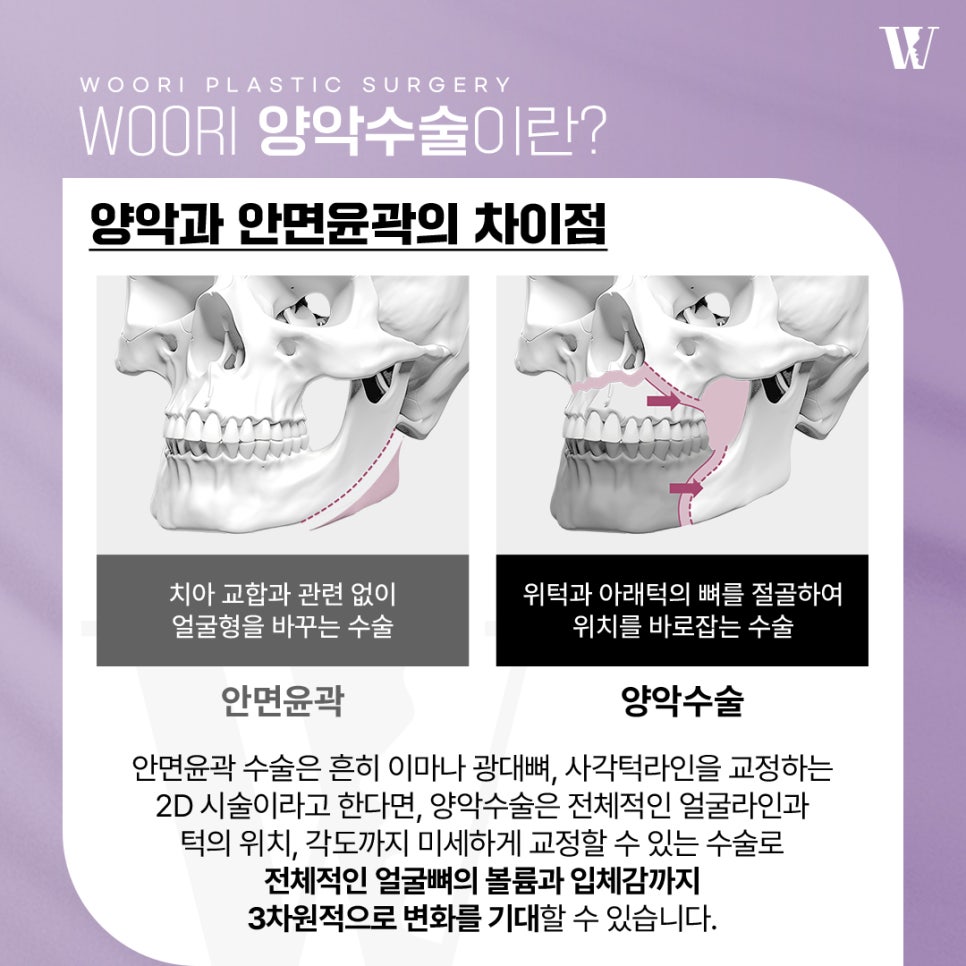 양악수술후기 주걱턱 돌출입 비대칭 케이스별 변화! 관련 이미지 2