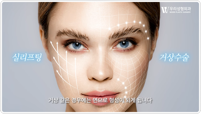 미니리프팅 유지기간은 얼마나 되나요? 관련 이미지 4