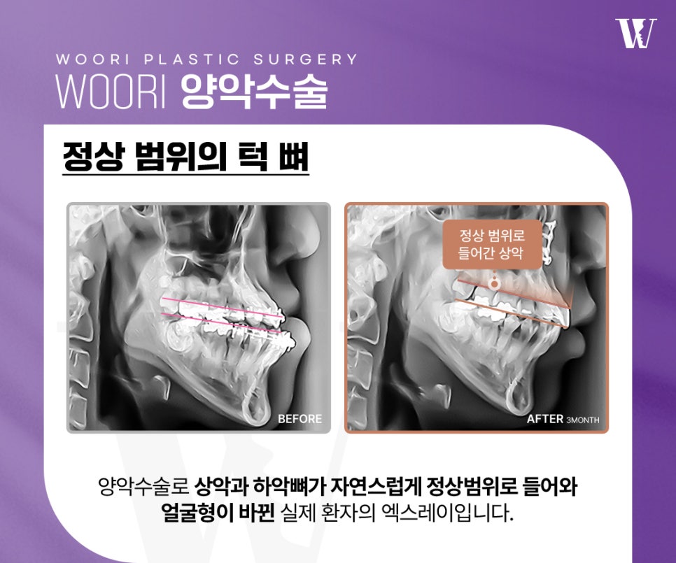 When Is Double Jaw Surgery Needed for Facial Asymmetry? image 5