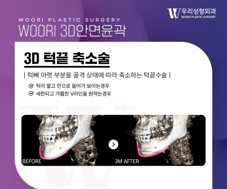 광대축소 윤곽수술 부위별 차이와 특징 관련 이미지 4