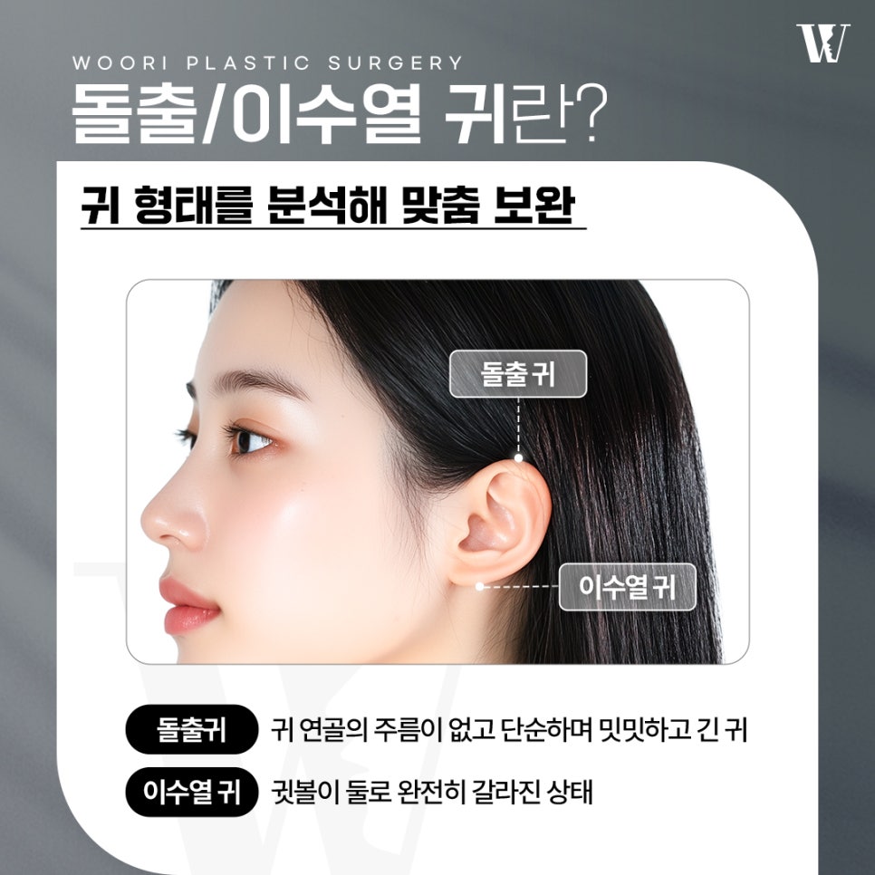 Otoplasty: Finding the Ear Contour That Suits Me image 2