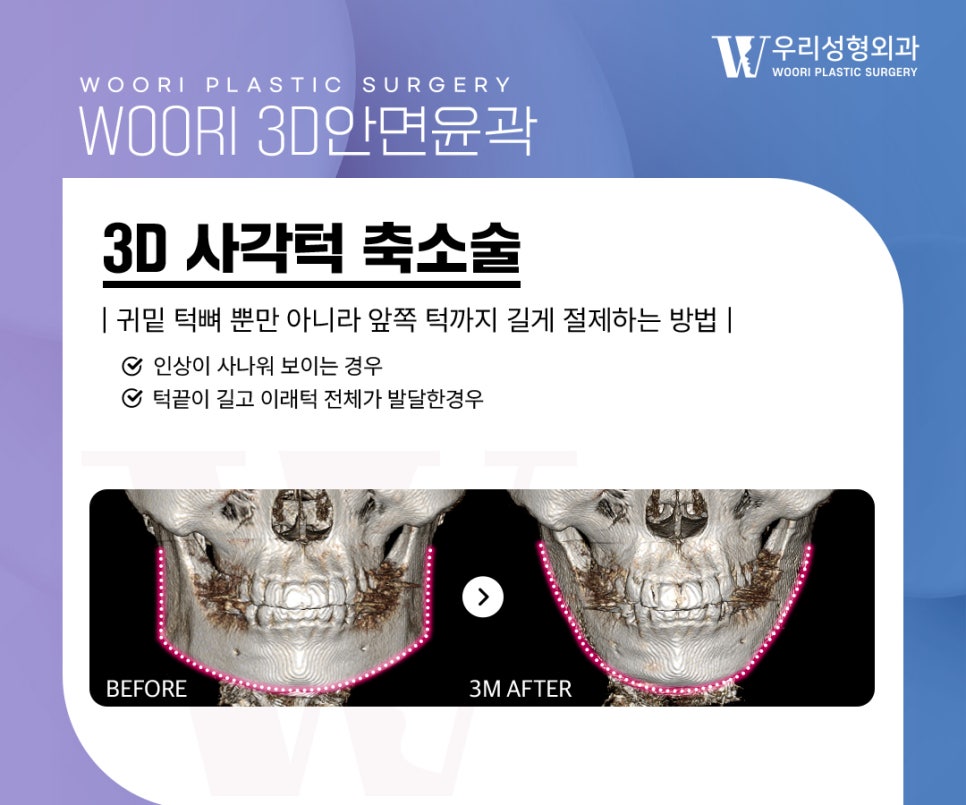 Why Are Cheekbones, Square Jaw, and Chin Often Treated Together in Facial Contouring Surgery? image 2
