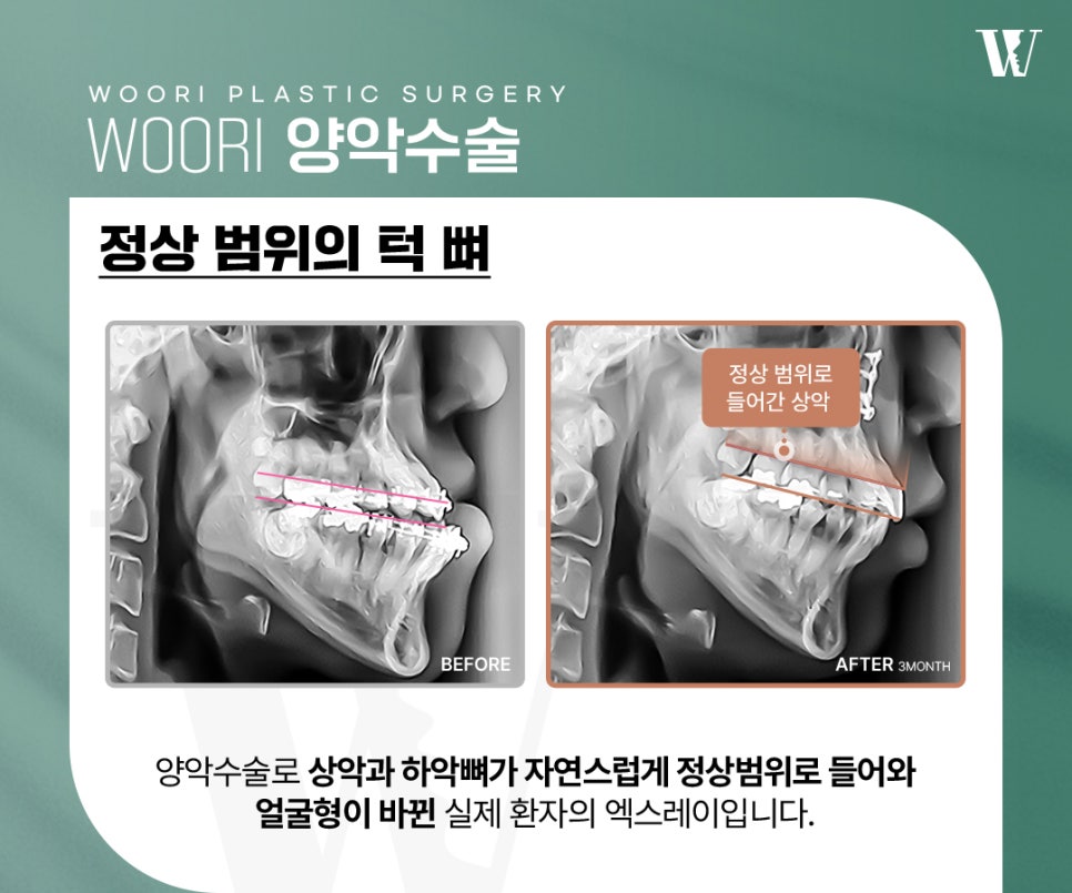 How Can the Facial Shape Change After Double Jaw Surgery? image 6
