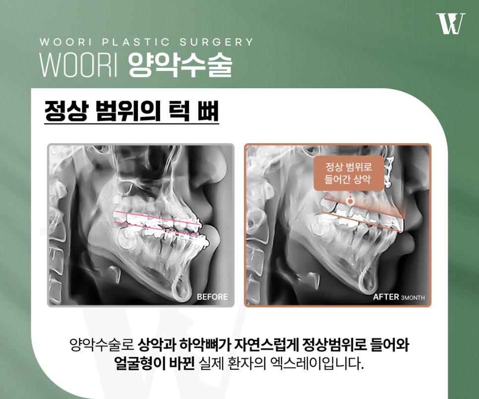What You Must Check Before Looking Up Orthognathic Surgery Reviews image 5