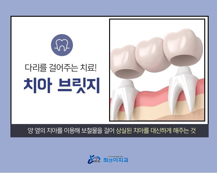 앞니브릿지가격 부담이 없어야 관련 이미지 5