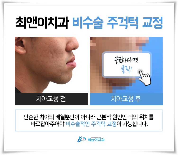 턱관절교정기 어울리는 방식으로 관련 이미지 5