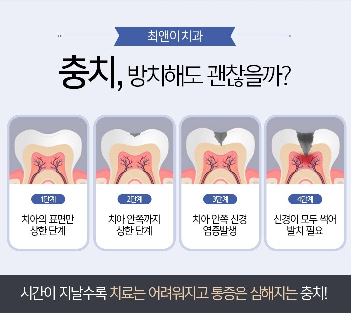 손상된 치아 레진 치료 받기 위해서는? 관련 이미지 6