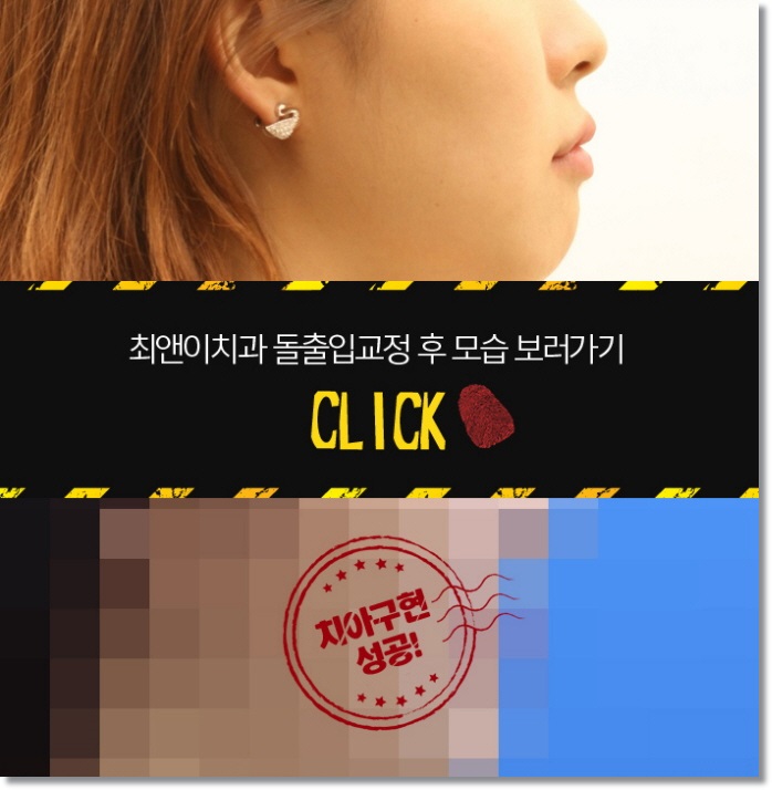 잇몸돌출교정 당황스럽지 않으려면 관련 이미지 7