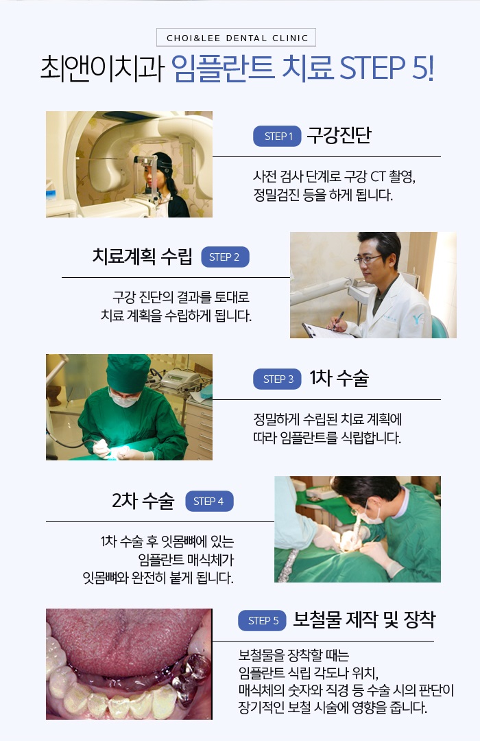 앞니임플란트가격 무엇을 봐야하나 관련 이미지 6