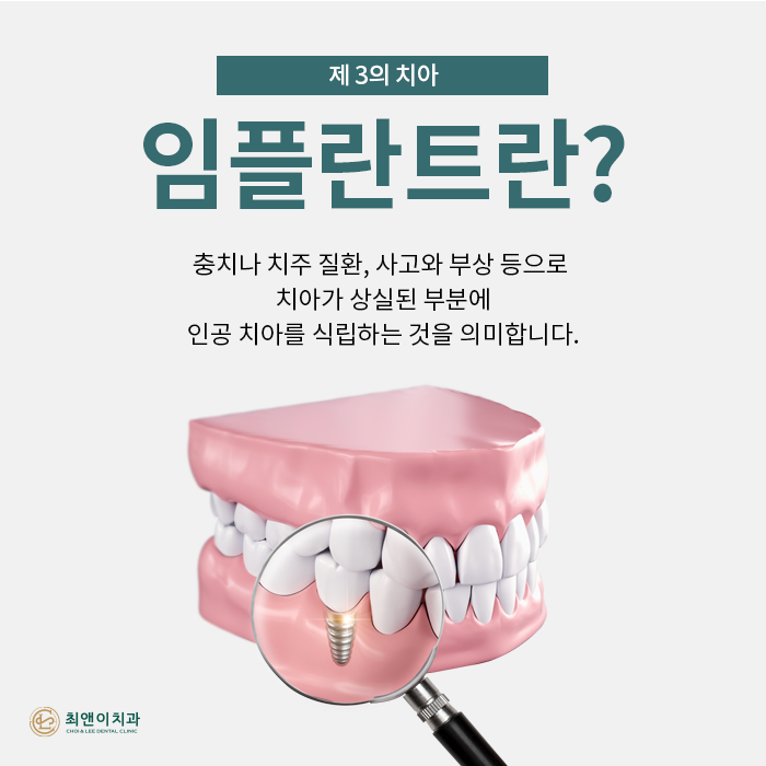 치아를 상실했을 때, 기능을 회복시켜주는 임플란트 관련 이미지 2