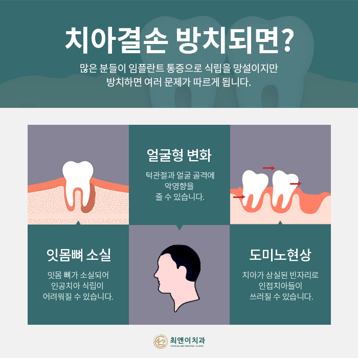 치아를 상실했을 때, 기능을 회복시켜주는 임플란트 관련 이미지 3