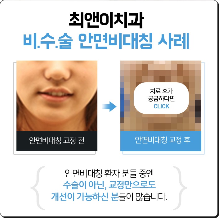 안면비대칭교정비용 밸런스가 잡히게 관련 이미지 4