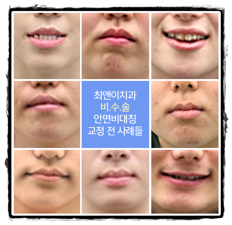 턱비대칭교정 알맞은 모습으로 바꾸자 관련 이미지 10
